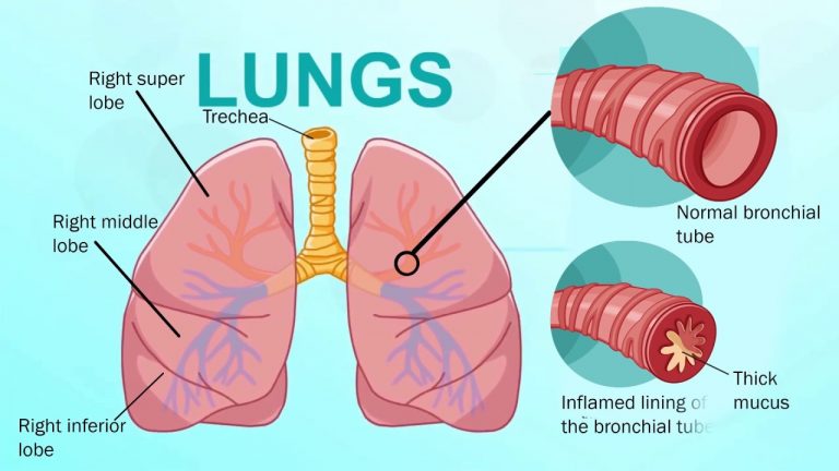 13-common-bronchitis-symptoms-signs-with-treatment