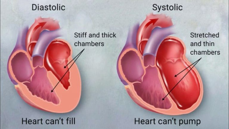 congestive-heart-failure-symptoms-stages-treatment