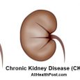 Chronic Kidney Disease, also known as CKD. Read About Stage 3 Kidney Disease Symptoms, Causes, Care, Diganosis, Reversal and Treatment. We Have Also Included Stage 3 CKD life Expectancy, Risks and Preventions along With Conclusion.