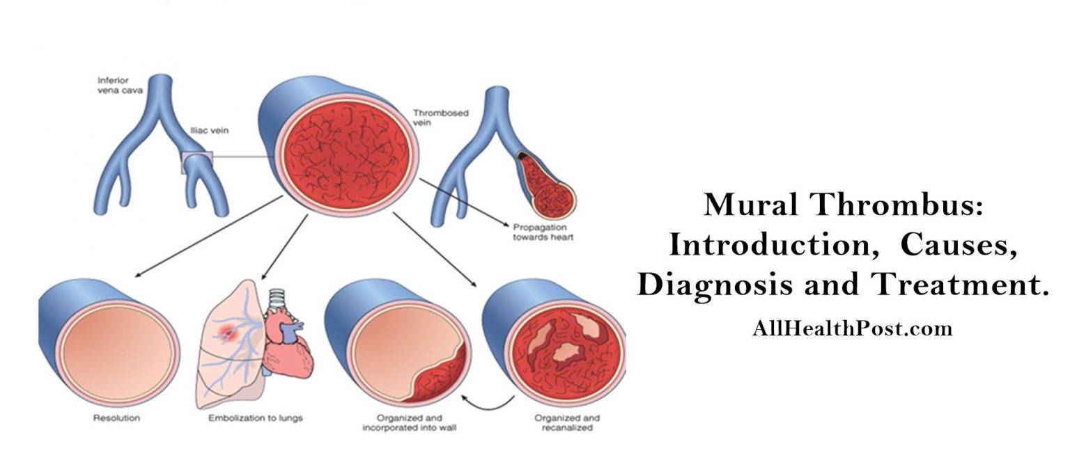 mural-thrombus-introduction-causes-diagnosis-treatment